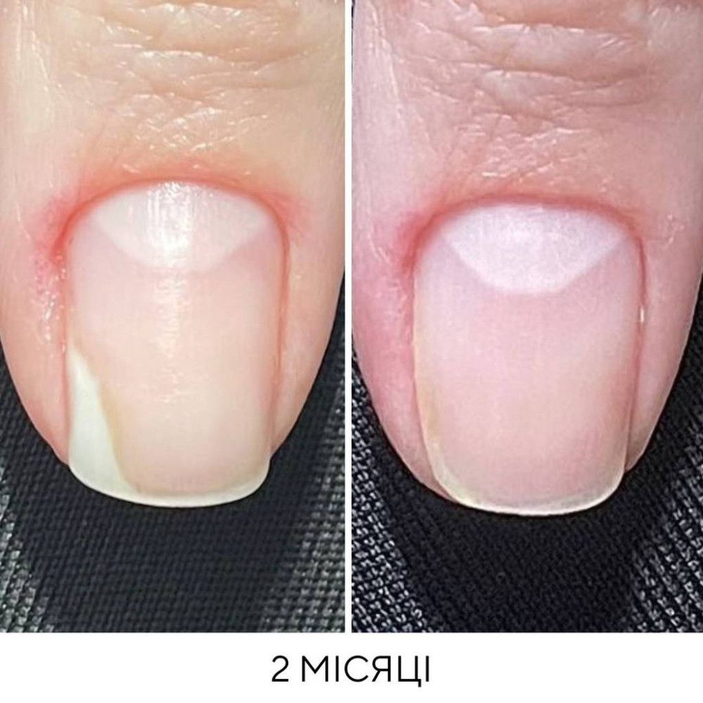 NAILSOFTHEDAY ONISTOP – регенеруюча олія проти оніхолізису, 15 ml